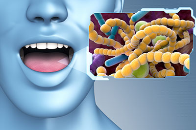 The image shows a 3D rendering of a human face with an open mouth, superimposed on which is a microscopic view of bacteria with a label indicating it s a  bacterial infection.