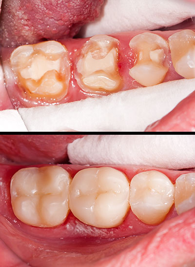 The image shows a close-up of a person s mouth with dental work being done, including a partial denture and multiple teeth with fillings.