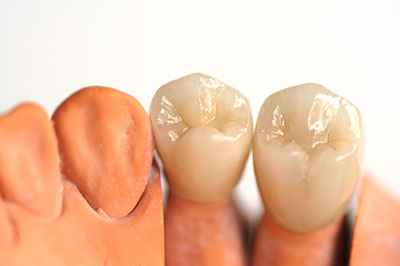 The image shows a set of artificial teeth with visible roots placed next to each other on a white background.