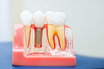 The image features a clear plastic dental model with several teeth, some with visible fillings and one with an exposed root canal area, showcasing dental implants or restorations.