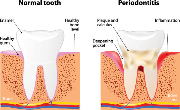 The image is a three-panel educational graphic illustrating the normal tooth structure, the progression of periodontitis with bone loss and inflammation, and the advanced stage of periodontitis showing significant bone resorption and gum pocket depth.