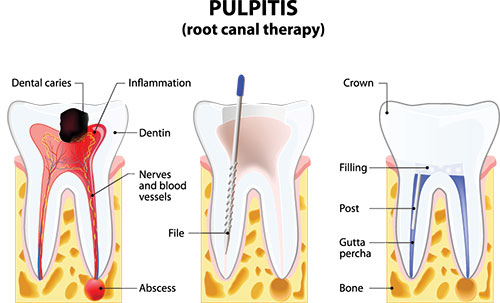 The image depicts a diagrammatic illustration of a human tooth with annotations, highlighting different parts such as dental caries, inflammation, and other oral health issues, along with a root canal therapy process.