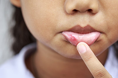 A young child with a visible skin condition on their face, touching their nose with a finger.