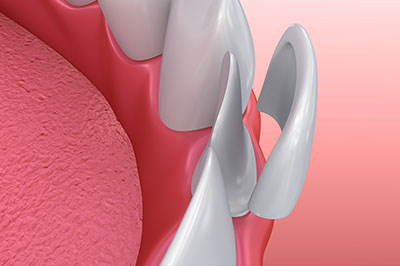 The image shows a close-up view of a dental implant with a metal screw extending outward from a pink gum surface, set against a red background.