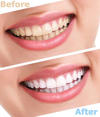 The image displays a before-and-after comparison of teeth whitening, showing a person s smile with two different shades of teeth whiteness.