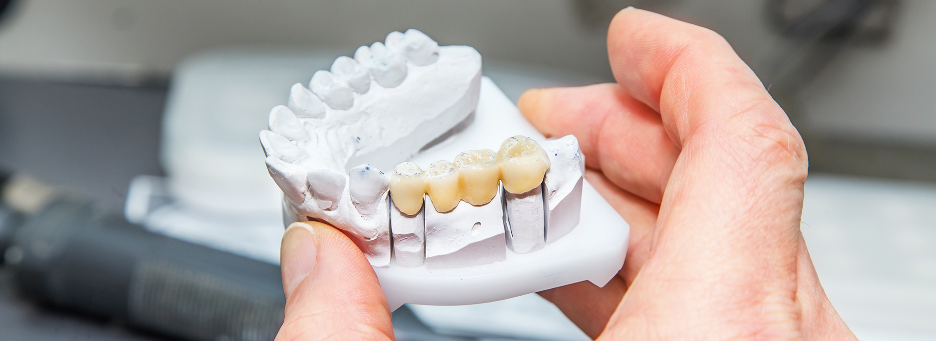 The image shows a person holding a 3D printed dental model with multiple teeth missing, likely for educational or demonstration purposes.