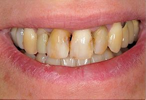 The image shows a close-up of a person s mouth with yellowed teeth and a partial smile, revealing some dental work such as fillings or crowns.